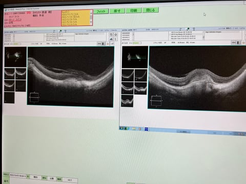 10月7日のＯＣＴ画像。向かって左側に10月7日の結果（新生血管の山が消えている画像、右に9月30日の画像と比較できるように並べている。）